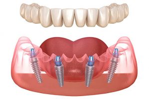 cursos implantologia dental cancun Cosmética Dental Azuna Cancún