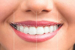 cursos implantologia dental cancun Cosmética Dental Azuna Cancún