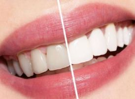 cursos implantologia dental cancun Cosmética Dental Azuna Cancún