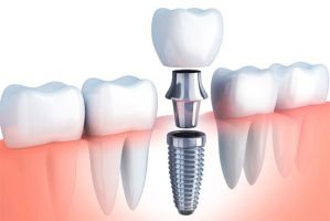 cursos implantologia dental cancun Cosmética Dental Azuna Cancún